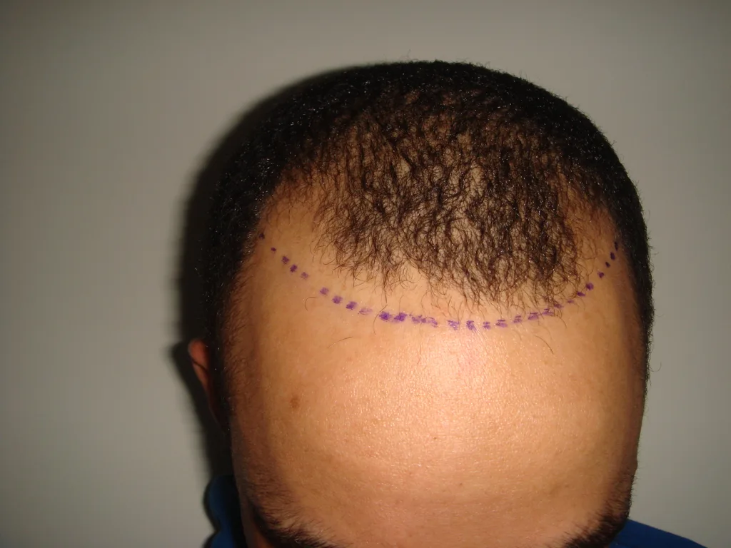 Westminster Medical Group® – Your Premier Hair Transplant UK Destination