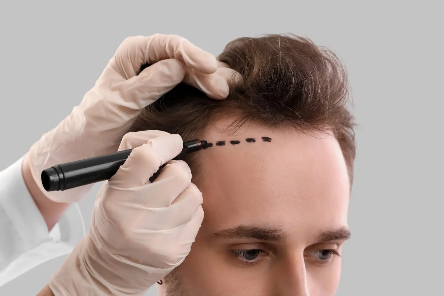 Hair Transplant UK – Proven Results You Can See