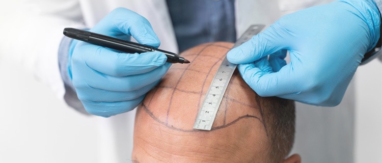 Hair Transplant Istanbul: Natural-Looking Results for Every Patient