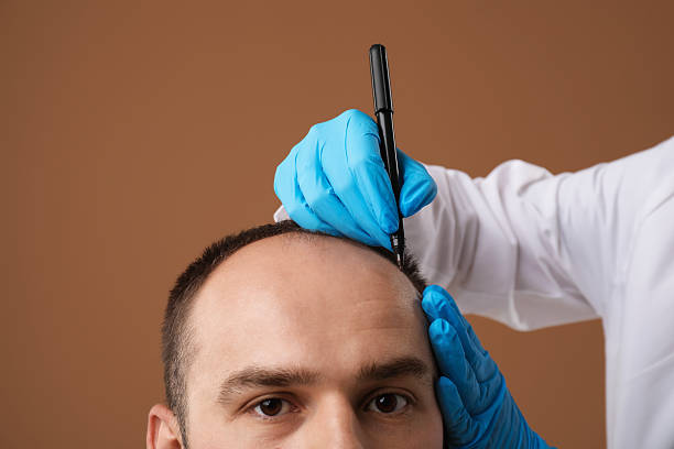 Hair Transplant Price: Affordable Solutions in Turkey